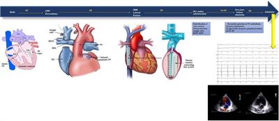 Case Report: Remote magnetic navigation and accessory pathways ablation in a single ventricle young adult with complex corrective surgeries